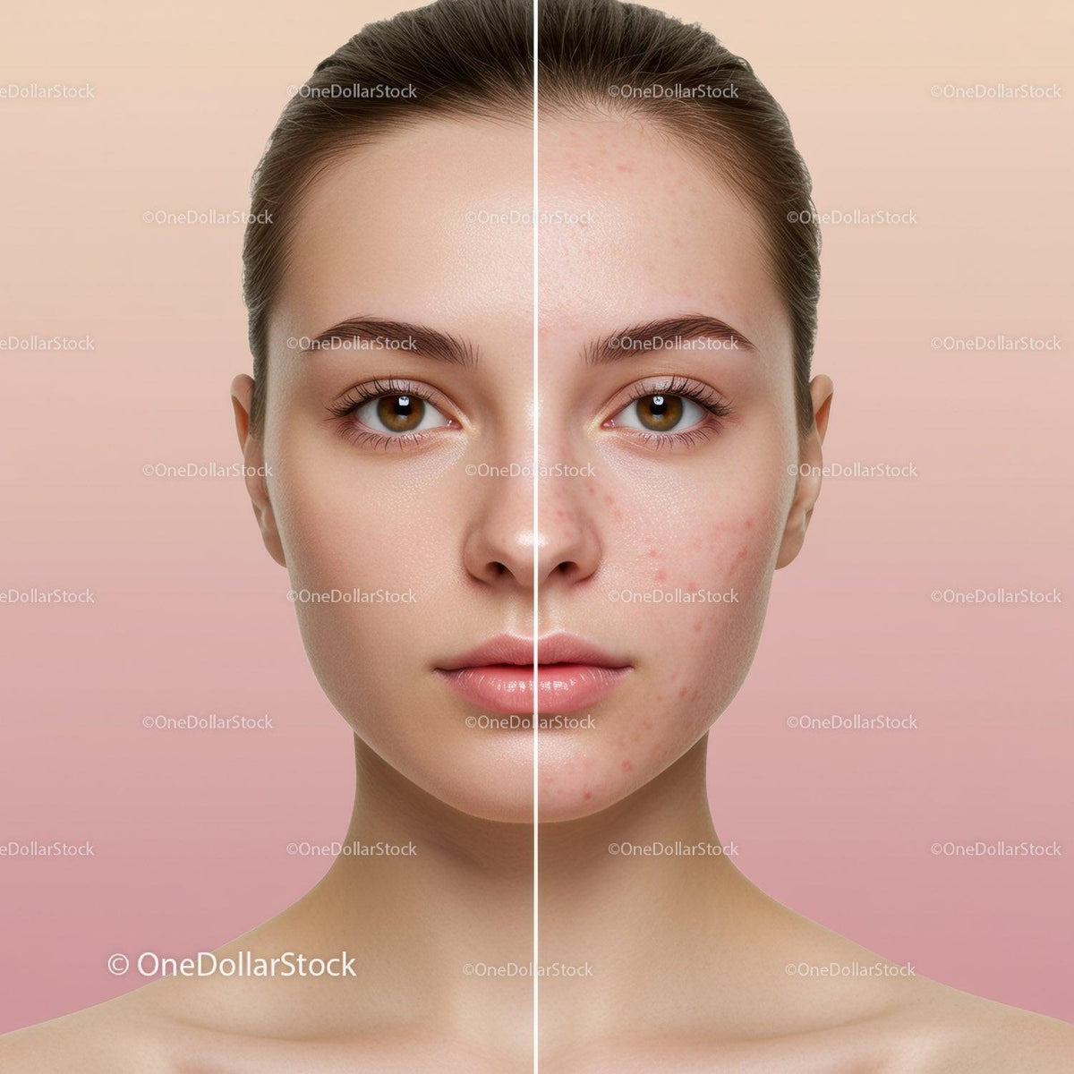 Close-Up of a Young Woman with Clear Skin and Acne on One Half