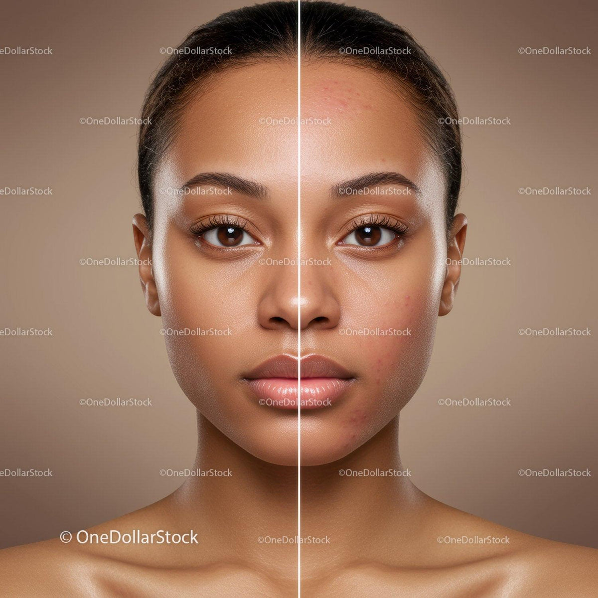 Close-up of Young Woman Face Showing Acne Before and After Treatment