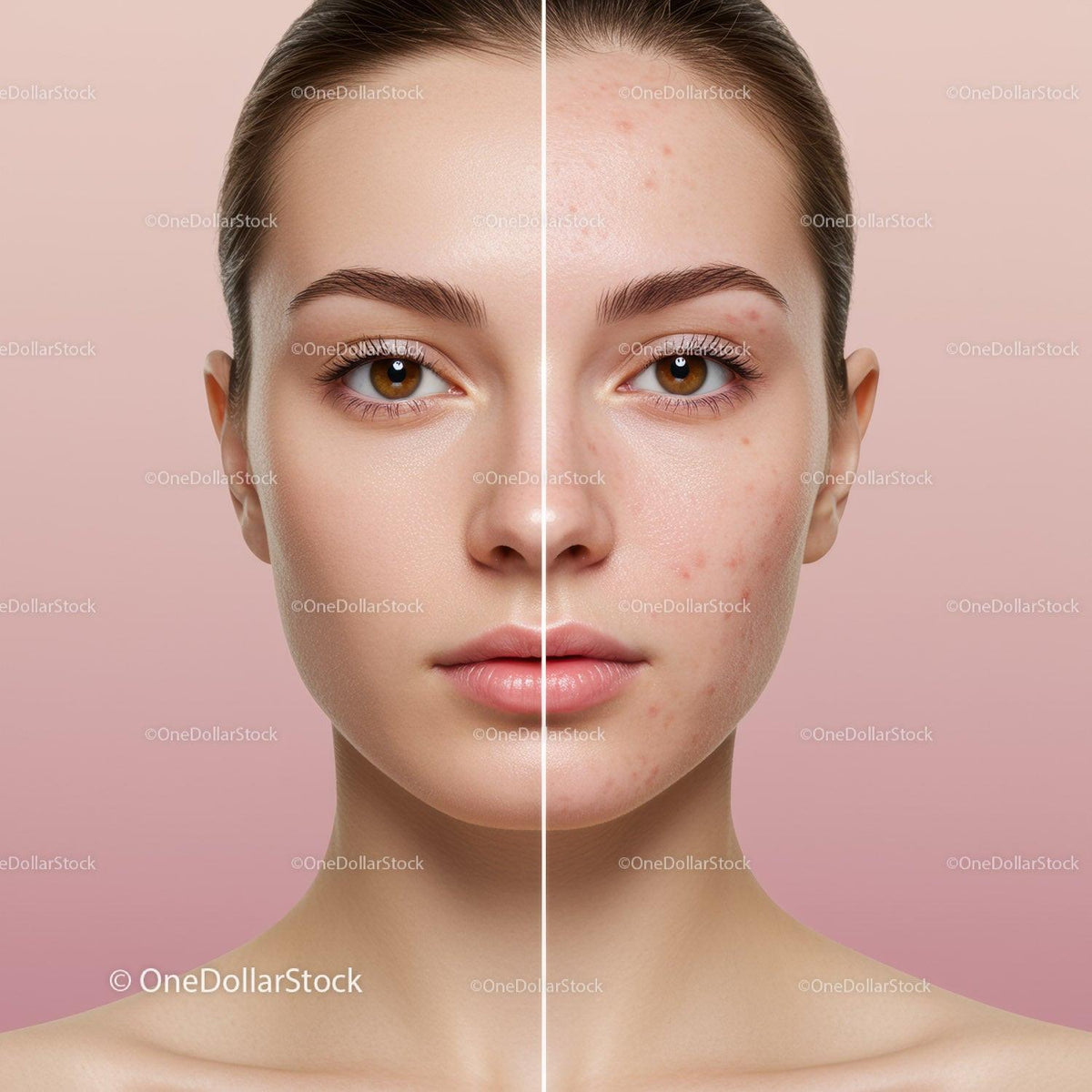 Clear Skin Transformation of Young Woman with Acne Prone Skin
