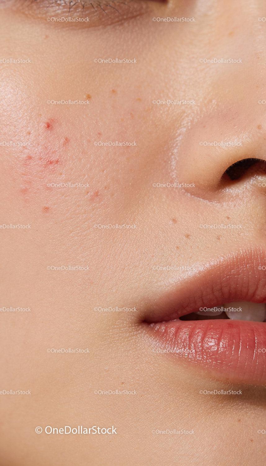 Close-up of natural female skin with acne and pores