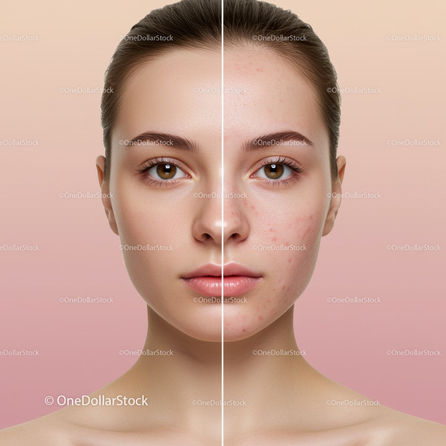 Close-Up of a Young Woman with Clear Skin and Acne on One Half