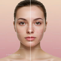 Close-Up of a Young Woman with Clear Skin and Acne on One Half