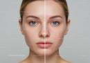 Close-up of Female Face Showing Acne Before and After Skin Care Treatment