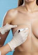 Medical Preparation for Breast Surgery with Surgical Markings
