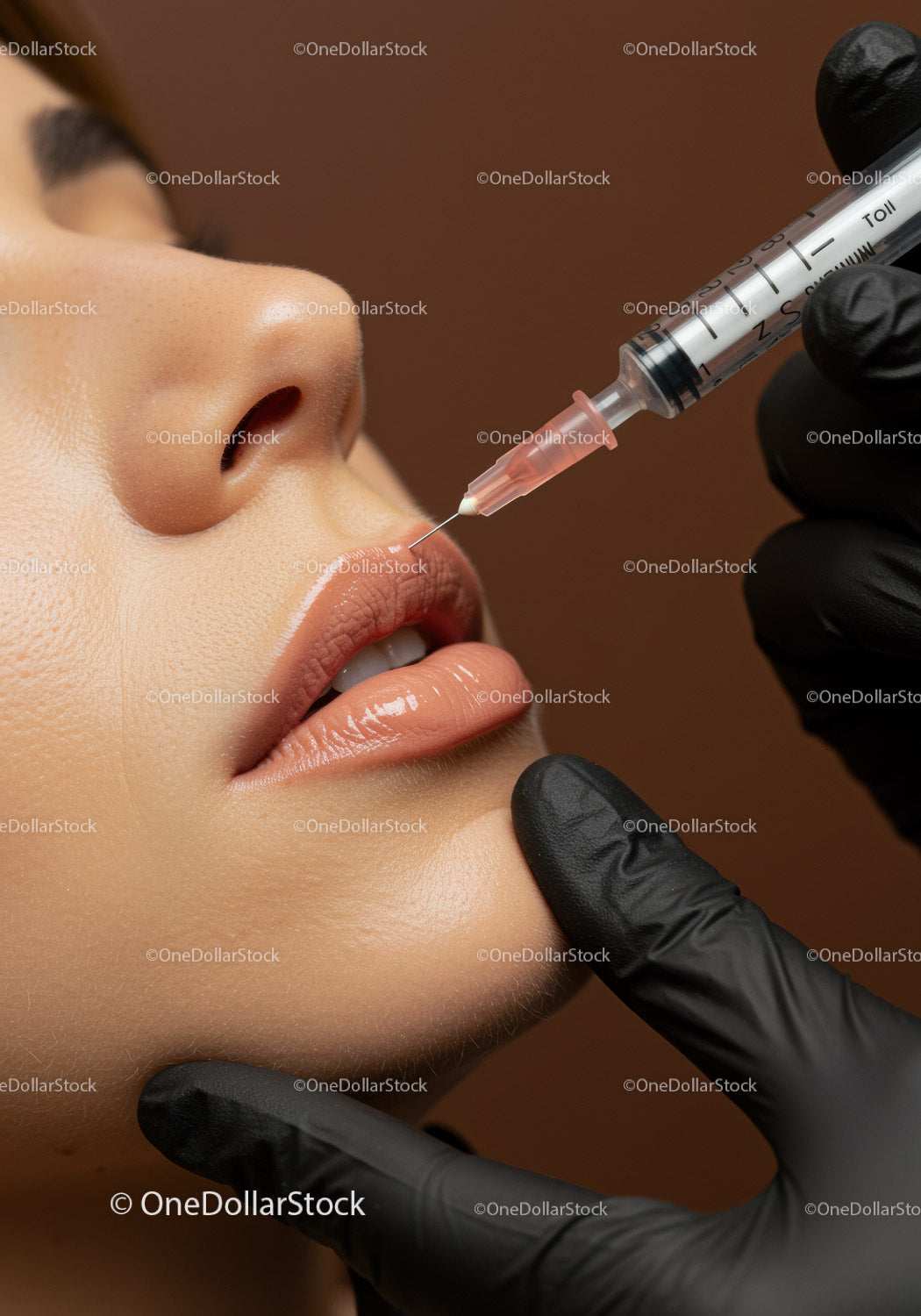 Close-Up of Lip Filler Injection Procedure for Lip Enhancement
