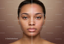 Split Face of Young Woman Showing Clear Skin and Acne Prone Skin