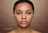 Split Face of Young Woman Showing Clear Skin and Acne Prone Skin
