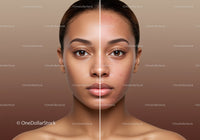 Before and After Acne Treatment Skin Transformation with Clear Complexion