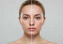Close-up of a Young Woman’s Face Showing Skin Acne and Clear Skin