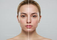 Close-up of a Young Woman’s Face Showing Skin Acne and Clear Skin