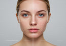 Young Woman with Clear Skin and Acne Prone Complexion