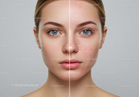 Young Woman with Clear Skin and Acne Prone Complexion