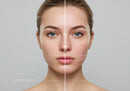 Beautiful Young Woman Showing Skin Improvement and Acne Healing