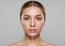 Clear Skin Transformation of a Young Woman with Acne Prone Skin