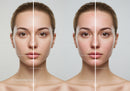 Young Woman with Clear Skin on One Side and Acne on the Other