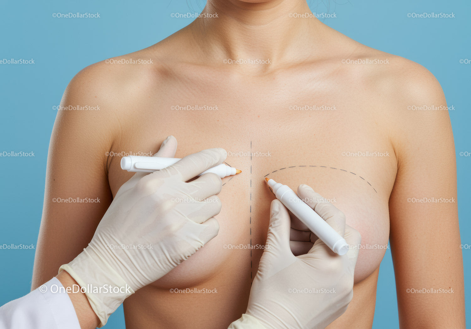 Close-Up of Breast Augmentation Markings for Cosmetic Surgery Procedure
