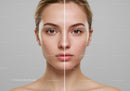Comparison of Skin Clarity and Acne Reduction Before and After Treatment