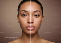 Young Woman's Face Split Showing Skincare Results with Clear and Acne-Prone Skin