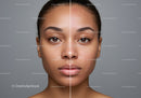 Side-by-Side Portrait of a Woman Showing Skin Improvement and Acne Reduction