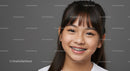 Young Girl With Bright Smile Wearing Braces on Gray Background