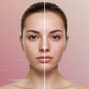 Clear Skin Before and After Acne Treatment Facial