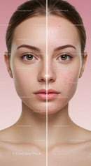 Clear Skin Transformation of Young Woman with Acne Prone Skin