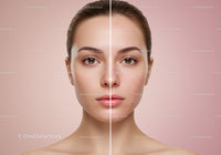 Skincare Transformation Face Portrait Showing Clear and Acne-Prone Skin