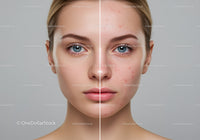 Close-Up Portrait of Young Woman with Acne Before and After Skincare