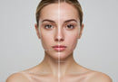 Close-up of a Young Woman's Face Showing Skin Improvement and Acne Healing