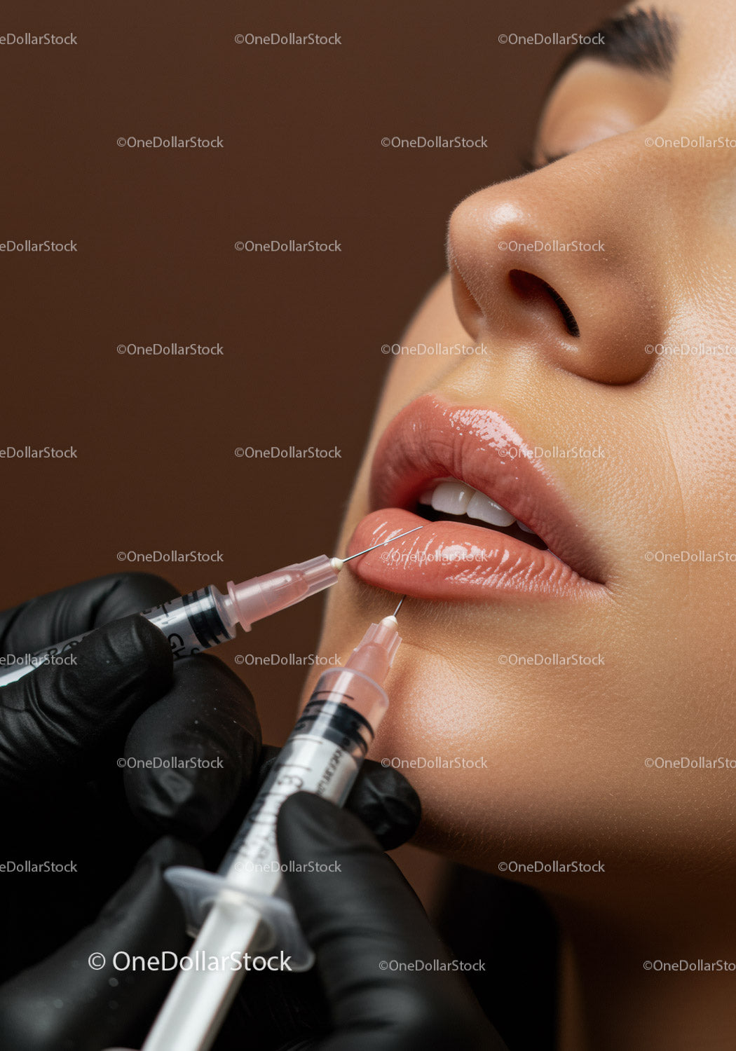 Close-up of Lip Filler Injection in Female Patient for Lip Enhancement