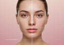 Close Up of Beautiful Woman Face Showing Acne Before and After Skin Care