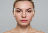 Before and After Skincare Treatment for Acne and Skin Rejuvenation