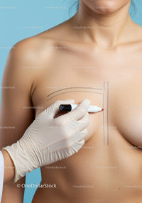 Woman with Surgical Markings Preparing for Breast Augmentation Procedure