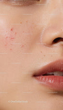 Close-up of natural female skin with acne and pores